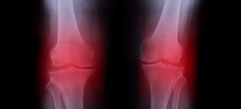 What Are 4 Causes Of Knee Pain