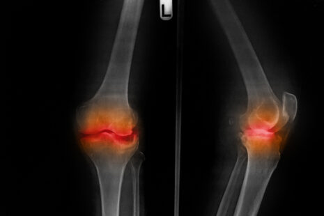 How Do You Repair Knee Cartilage Without Surgeryv