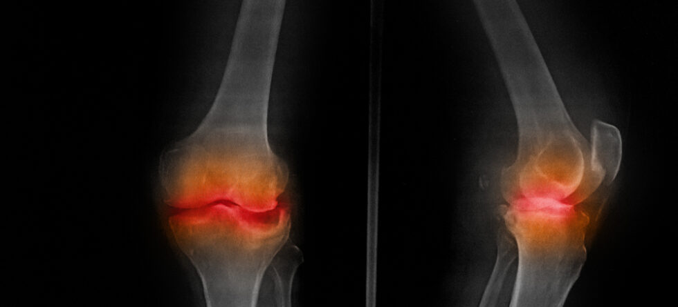 How Do You Repair Knee Cartilage Without Surgeryv